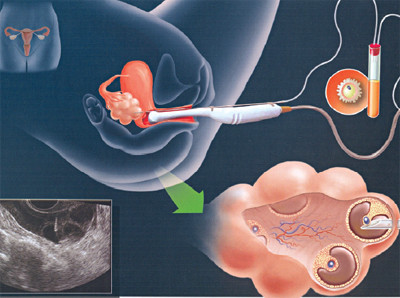 Phác đồ kích thích buồng trứng mới GI giúp phụ nữ vô sinh