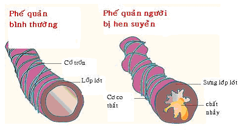 Nhận biết các loại hen suyễn