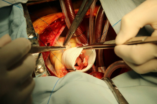 Tạo hình van động mạch chủ và thay đoạn mạch nhân tạo. Ảnh:P.T Tạo hình van động mạch chủ và thay đoạn mạch nhân tạo. Ảnh: P.T