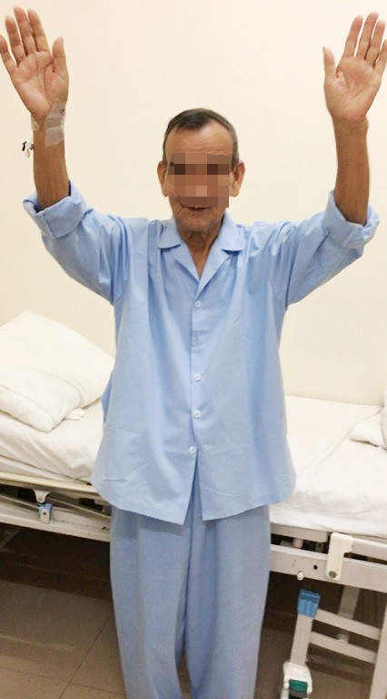 Đột quỵ liệt nửa người, cụ ông 82 tuổi đi lại bình thường sau 2 ngày được cứu sống ảnh 1