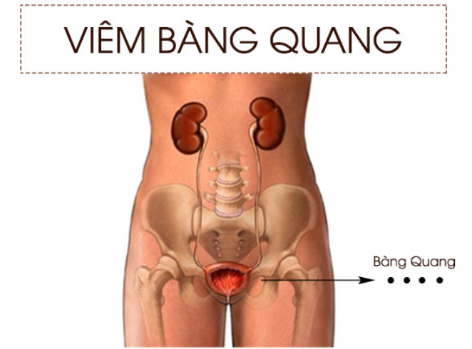 Viêm bàng quang có thể dẫn đến nhiều biến chứng tới sức khỏe Viêm bàng quang có thể dẫn đến nhiều biến chứng tới sức khỏe