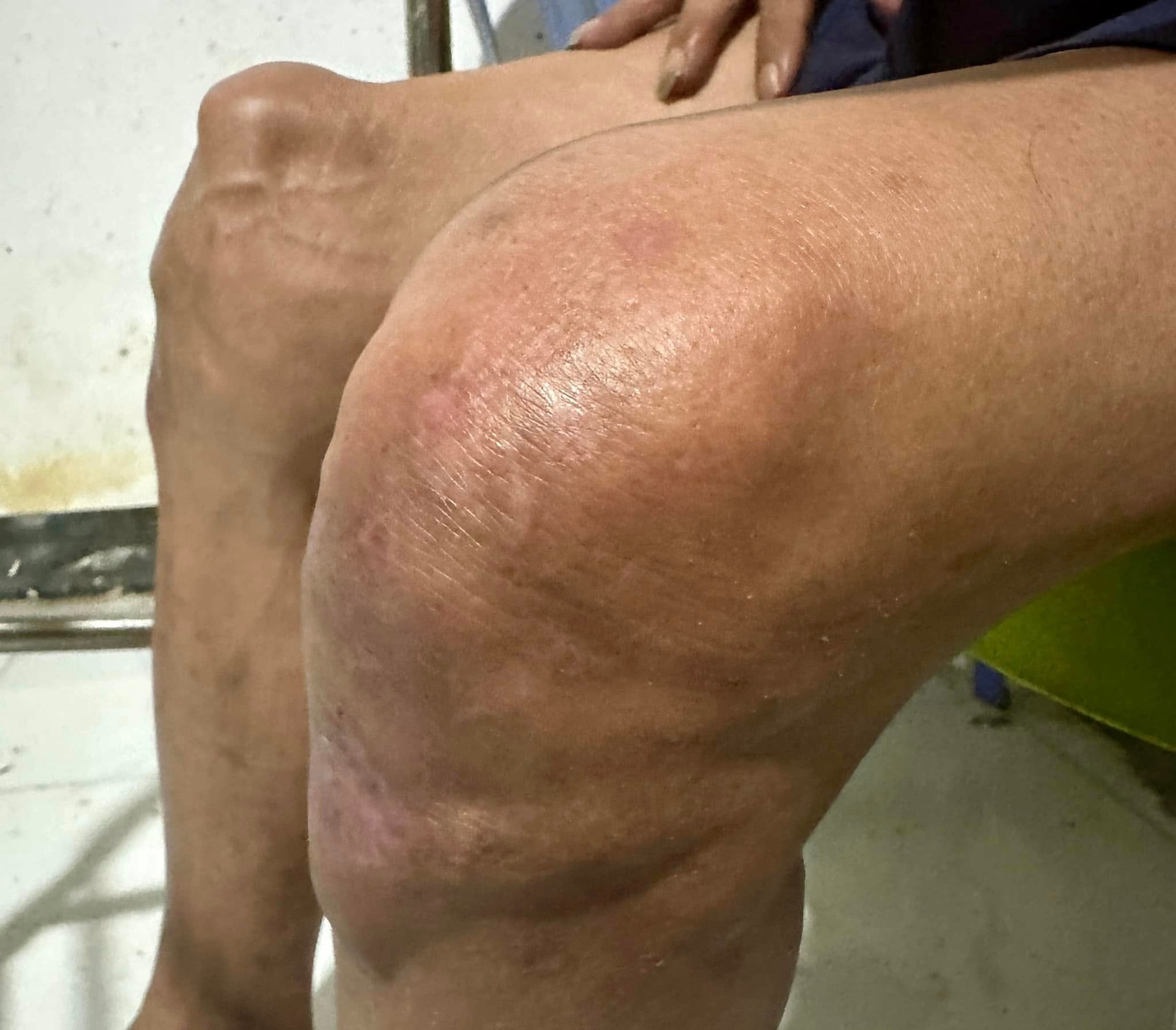 Nghệ sĩ Thương Tín không thể đi lại do hai chân sưng phù, chưa rõ nguyên nhân.