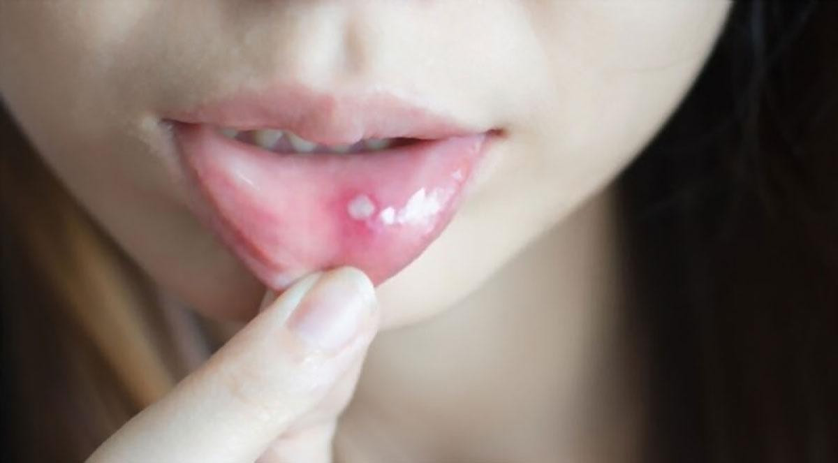 Có đến khoảng 20% dân số bị nhiệt miệng thường xuyên. Có đến khoảng 20% dân số bị nhiệt miệng thường xuyên.