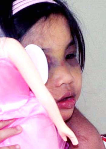 Khuôn mặt bé Thục Phi còn sưng, mắt còn bầm đang được tiếp tục điều trị ở Bệnh viện đa khoa Quảng Ngãi