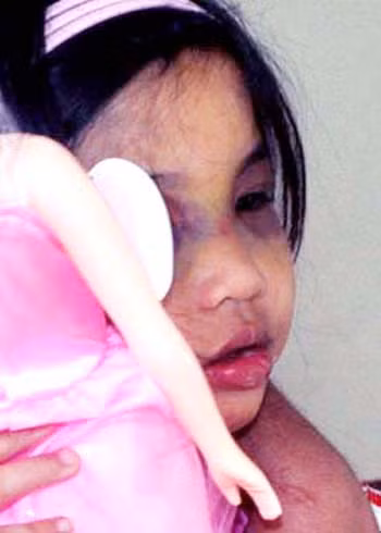 Khuôn mặt bé Thục Phi còn sưng, mắt còn bầm đang được tiếp tục điều trị ở Bệnh viện đa khoa Quảng Ngãi
