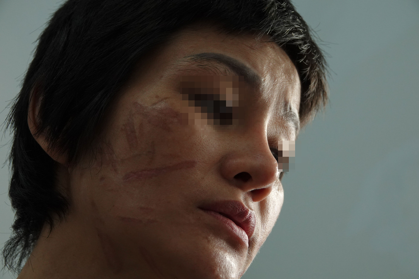 Vết thương trên mặt chị G.