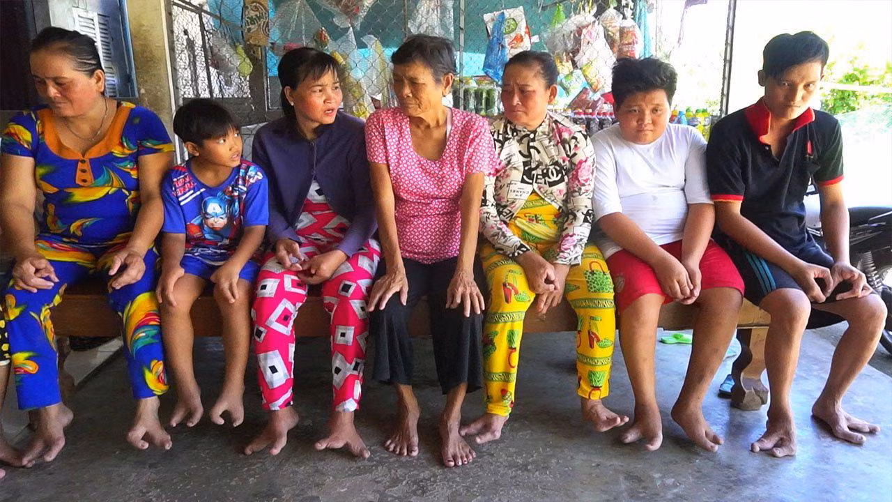 Nếu tính cả gia đình 3 thế hệ thì có đến 13 người có chân tay dị dạng, chỉ từ 2 đến 3 ngón. Nếu tính cả gia đình 3 thế hệ thì có đến 13 người có chân tay dị dạng, chỉ từ 2 đến 3 ngón.