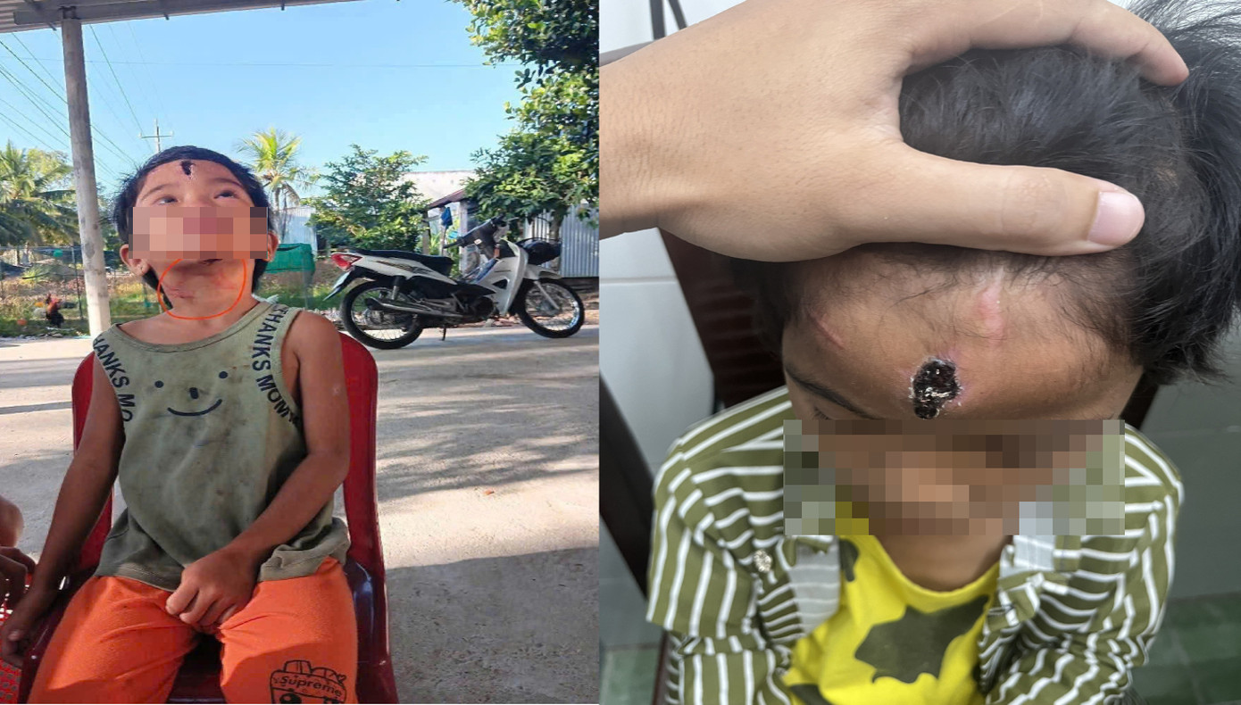 Vết thương cháu N.T.N bị cha dượng đánh đập.