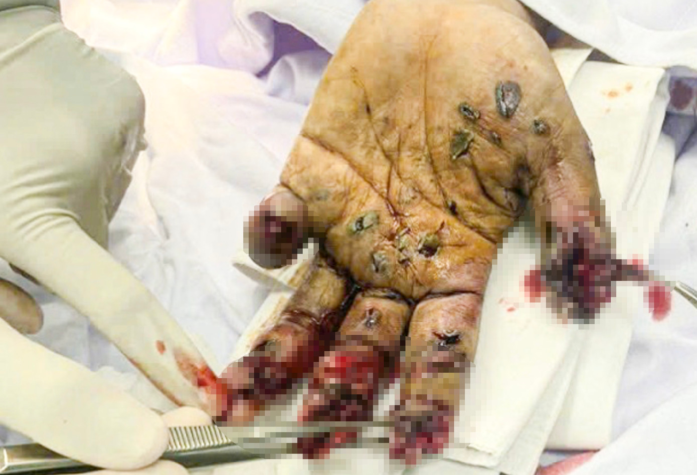 Bàn tay bị dập nát do pháo tự chế.