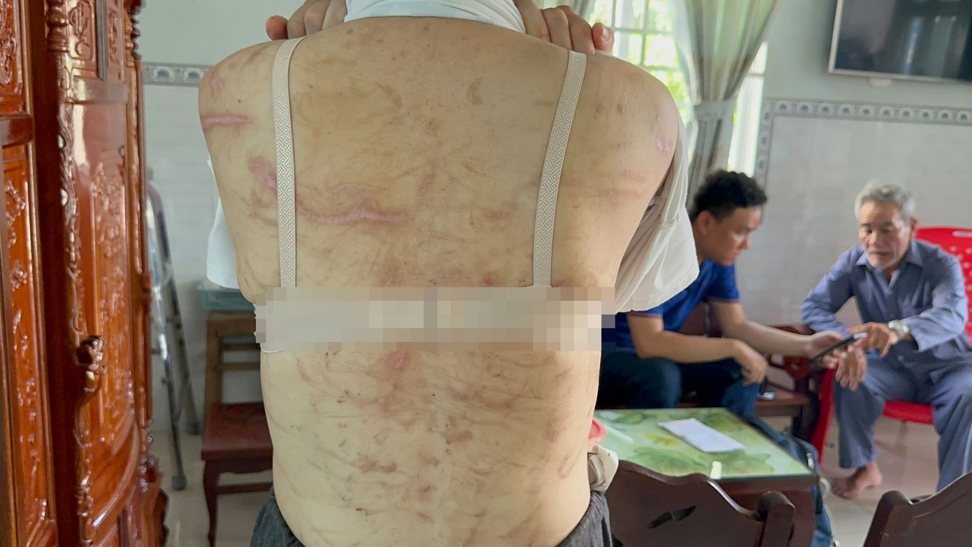 Trên người chị G. chi chít vết thương. Ảnh: PV. Trên người chị G. chi chít vết thương. Ảnh: PV.