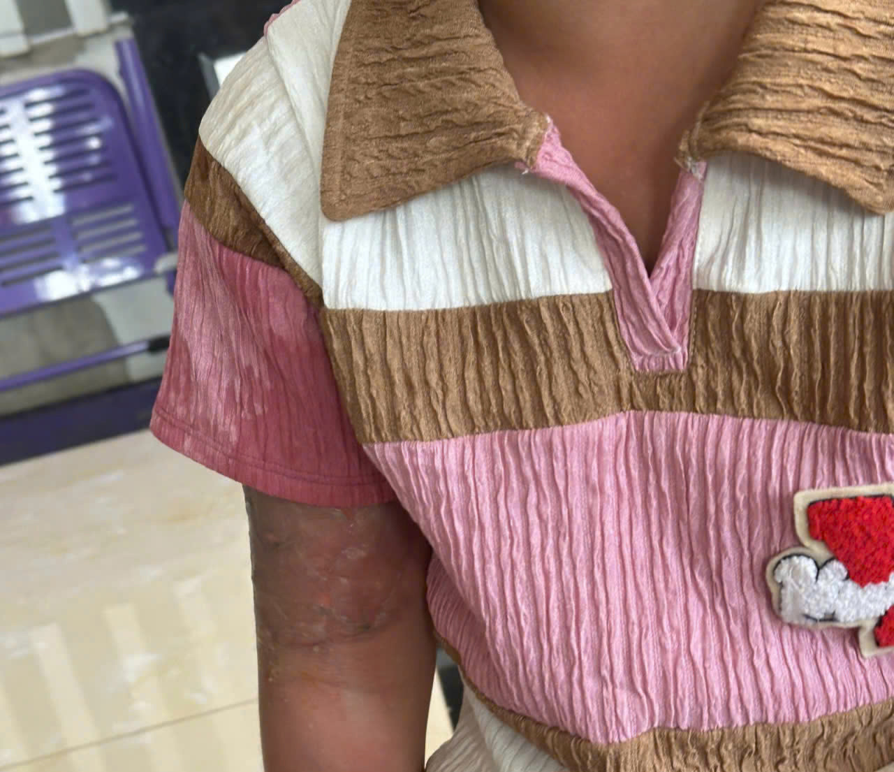 Cánh tay phải bé gái bị bỏng do "mẹ nuôi" tạt nước sôi.