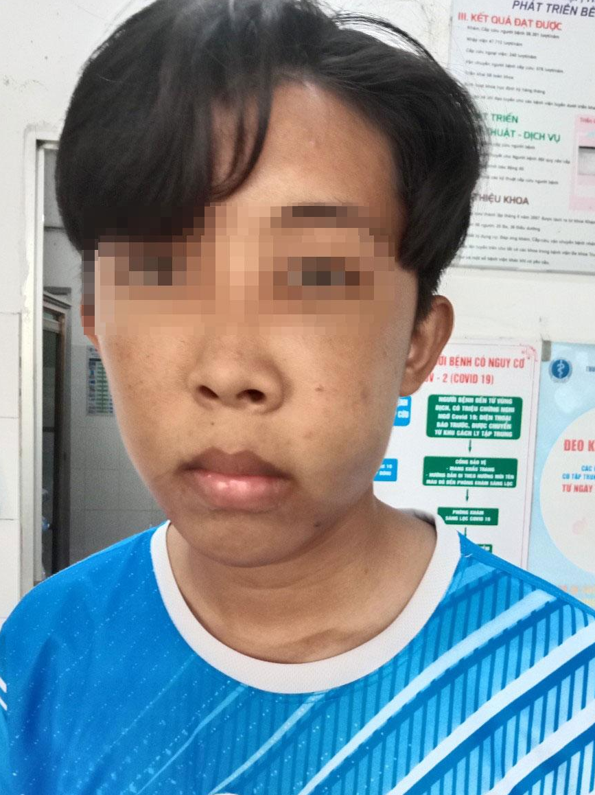 Nam sinh bị gãy xương hàm, tụ dịch xoang hàm trái. Nam sinh bị gãy xương hàm, tụ dịch xoang hàm trái.