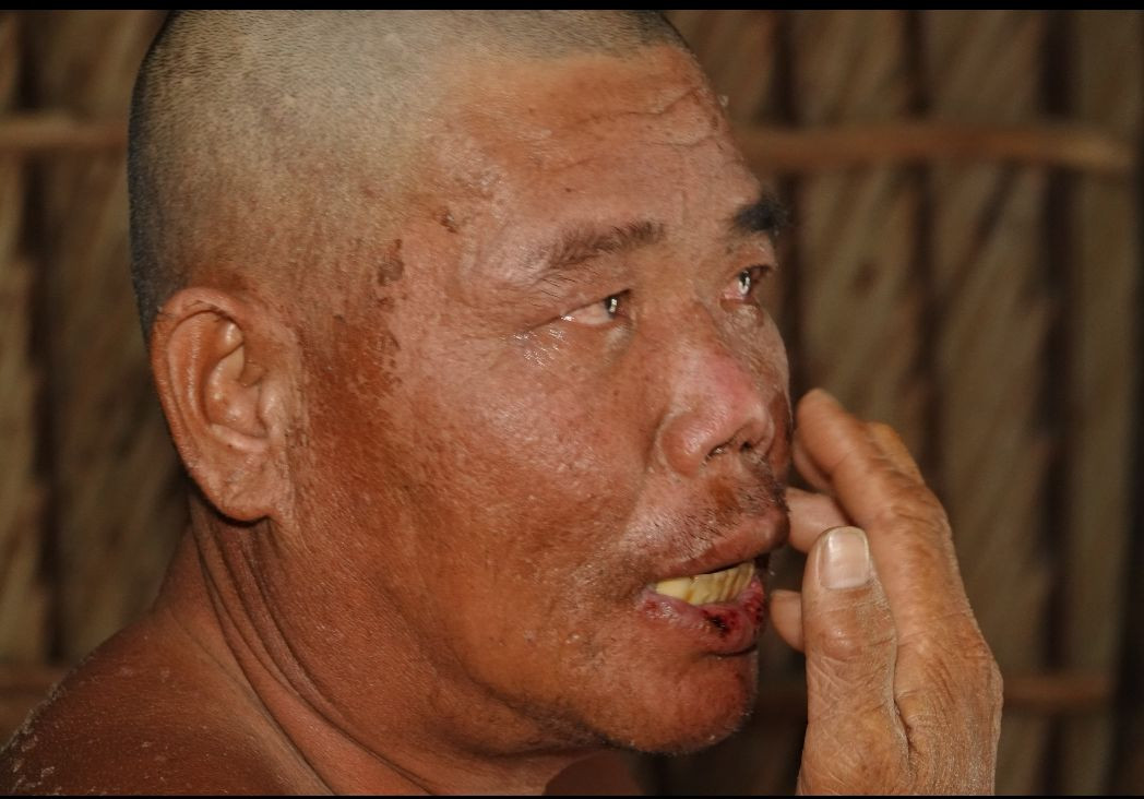 Gương mặt người đàn ông với nhiều vết thương do ngâm nước biển quá lâu.