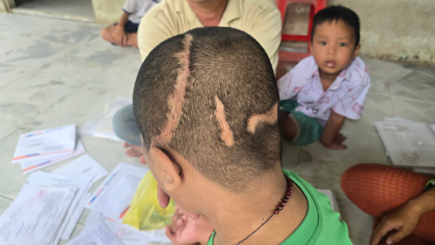 Bé N. trải qua 7 lần phẫu thuật, với nhiều vết sẹo trên đầu.