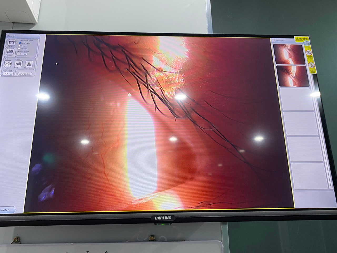 Rận mi chi chít trên mắt bé gái 5 tuổi.