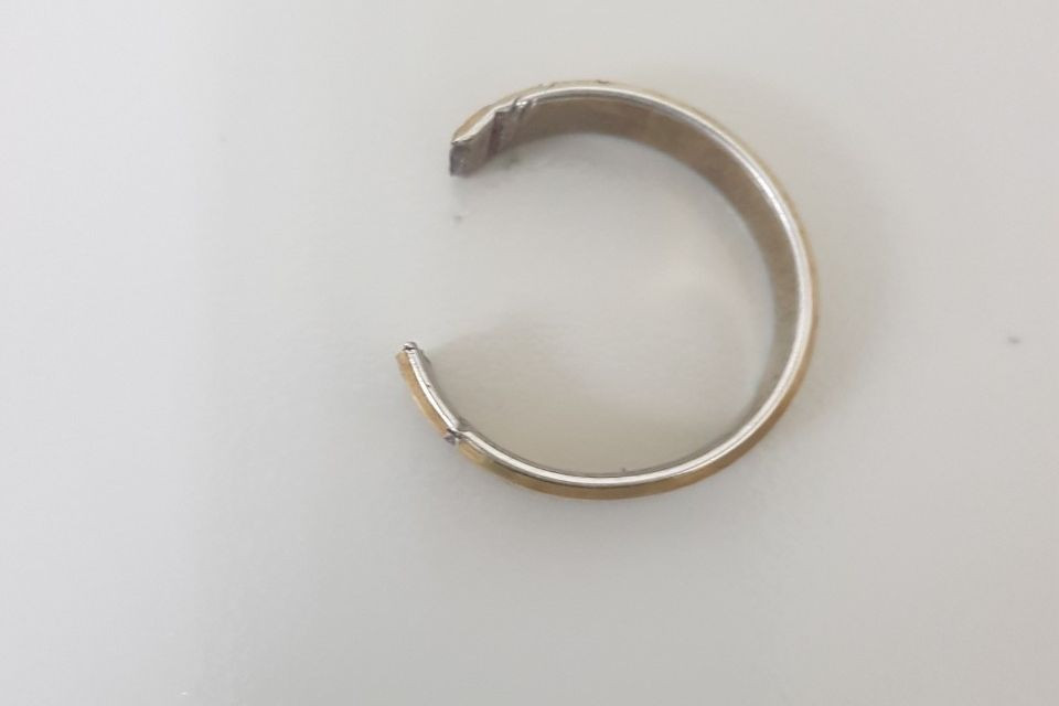 Chiếc nhẫn được các bác sĩ cắt ra từ dương vật bệnh nhân. Chiếc nhẫn được các bác sĩ cắt ra từ dương vật bệnh nhân.