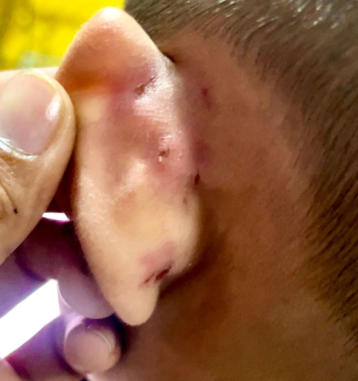 Thương tích trên người bé M.