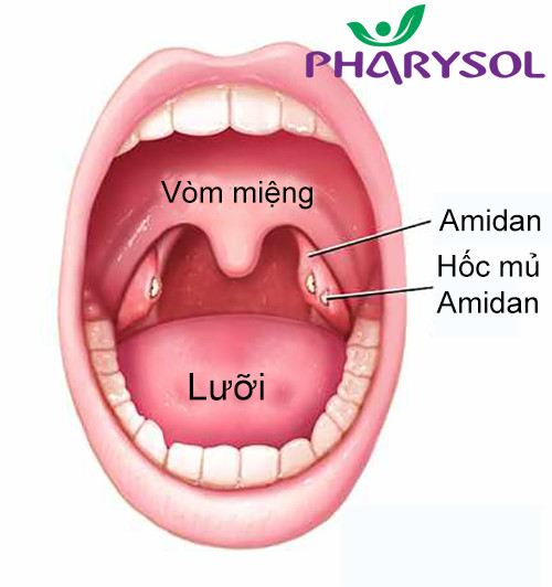 3 vấn đề quan trọng người bị viêm amidan cần biết ảnh 1