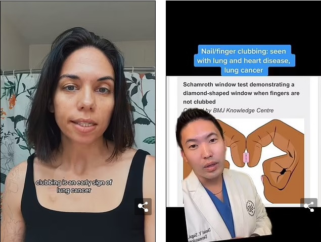 Cô Ashley Vassallo (trái), người được chẩn đoán mắc ung thư phổi giai đoạn bốn ở tuổi 30, cho biết cô đã trải qua hiện tượng ngón tay dùi trống như một trong những triệu chứng đầu tiên của cô. Ông Daniel Sugai, một bác sĩ da liễu ở thành phố Seattle (Mỹ), nói trên TikTok rằng ông khuyến nghị thử nghiệm này để kiểm tra hiện tượng ngón tay dùi trống. Nguồn: Mail Online. Cô Ashley Vassallo (trái), người được chẩn đoán mắc ung thư phổi giai đoạn bốn ở tuổi 30, cho biết cô đã trải qua hiện tượng ngón tay dùi trống như một trong những triệu chứng đầu tiên của cô. Ông Daniel Sugai, một bác sĩ da liễu ở thành phố Seattle (Mỹ), nói trên TikTok rằng ông khuyến nghị thử nghiệm này để kiểm tra hiện tượng ngón tay dùi trống. Nguồn: Mail Online.