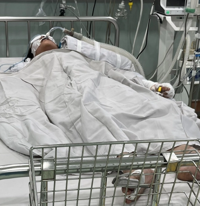 Bệnh nhi điều trị bỏng tại Bệnh viện Nhi đồng 1. Ảnh: BVCC.