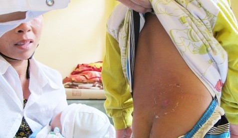 Người dân bị kiến ba khoang tấn công. Ảnh: Dân Trí