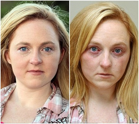 Những nốt đỏ trên mặt Katie khi cô khóc (ảnh phải)