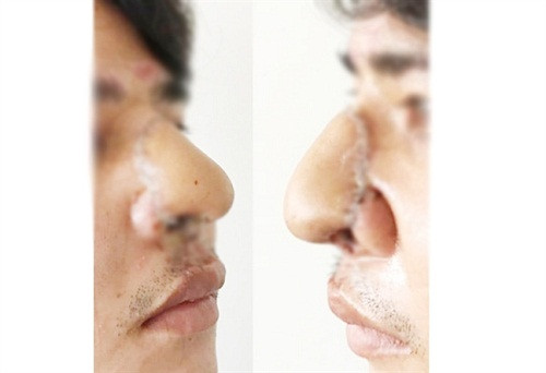 Đầu mũi bị chém bay được tái tạo “'thần kỳ' nhờ da cẳng tay ảnh 1