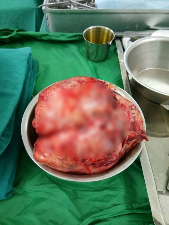 Thường xuyên ói sau ăn, bệnh nhân suýt chết vì khối u 2,5 kg ảnh 2