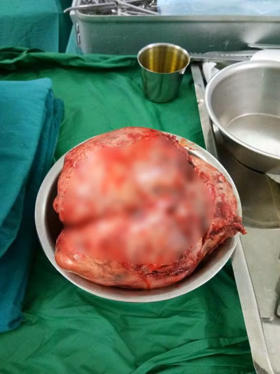 Thường xuyên ói sau ăn, bệnh nhân suýt chết vì khối u 2,5 kg ảnh 2