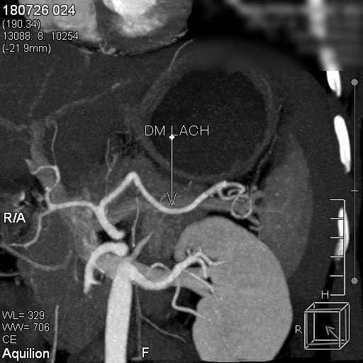 Suýt chết vì vỡ lách sau tai nạn giao thông dù không chảy máu ảnh 1