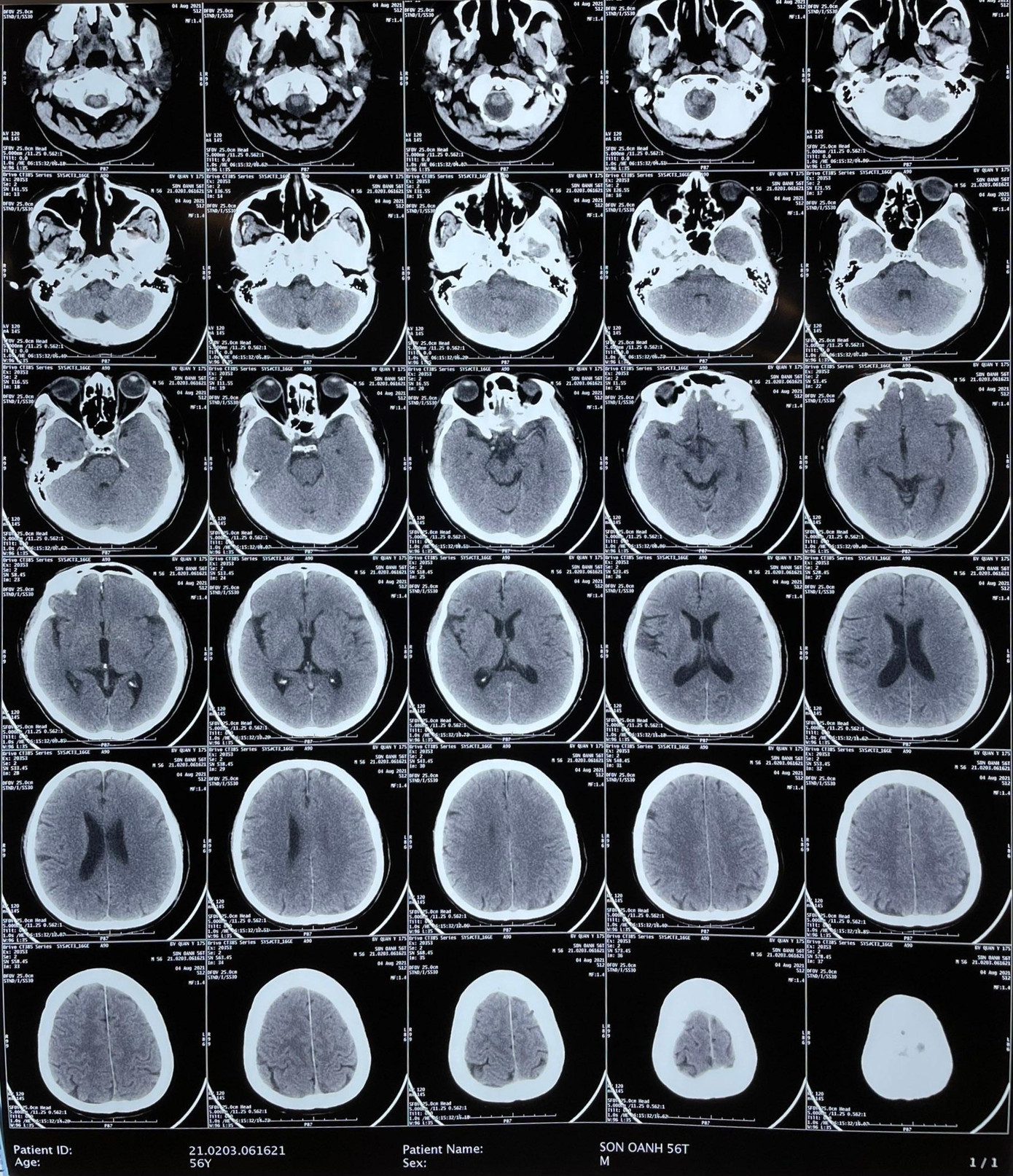 Hình ảnh chụp CT não bệnh nhân.