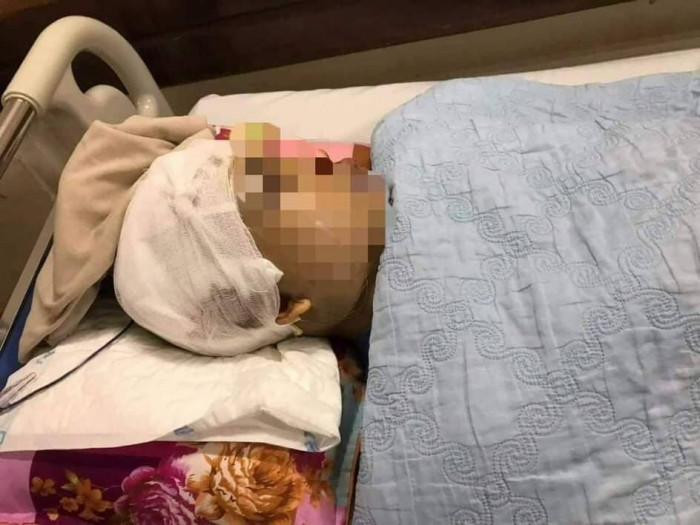 Phó Chủ tịch UBND xã An Thượng bị đánh vỡ hộp sọ, đang phải nhập viện điều trị. Phó Chủ tịch UBND xã An Thượng bị đánh vỡ hộp sọ, đang phải nhập viện điều trị.
