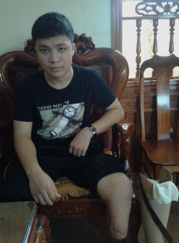 Em Nguyễn Thế Thức đã phải lắp chân giả để đi lại. Hơn 1 tháng qua em đã phải nhờ bố chở đi học