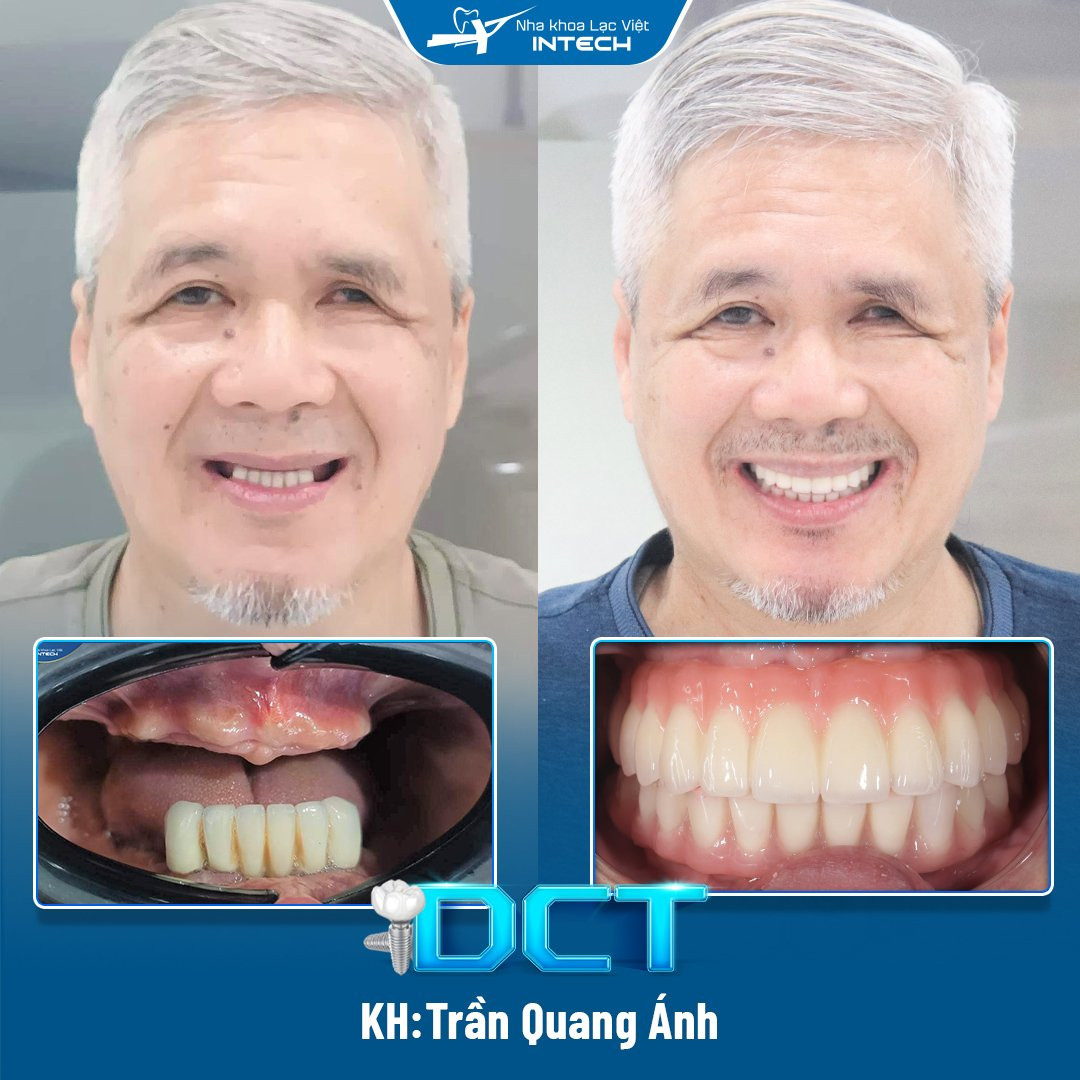 DCT sử dụng trụ phục hình và răng sứ được thiết kế cá nhân hóa mang lại kết quả trồng răng implant thẩm mỹ, bền chắc tối đa (Ảnh: Nha khoa Lạc Việt Intech)