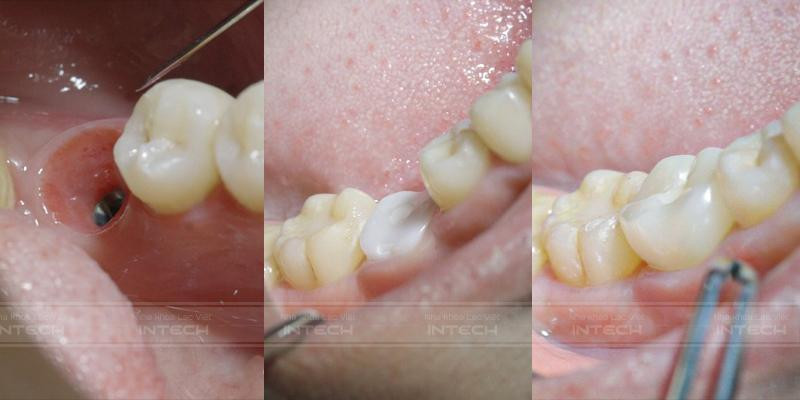 Kết quả trồng răng implant đạt thẩm mỹ hoàn hảo nhờ công nghệ DCT (Ảnh: Nha khoa Lạc Việt Intech)