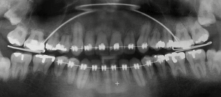 Chân răng bị tiêu trong quá trình niềng răng khiến răng yếu