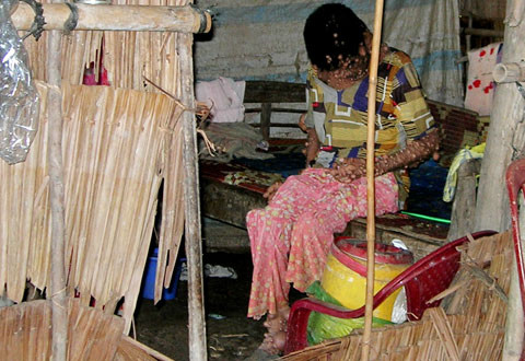 Chị Sa Ly với hàng nghìn mụn thịt trên người