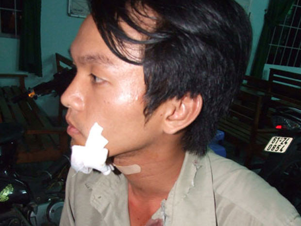 Anh Nguyễn Hoàng Thiên, thành viên câu lạc bộ phòng chống tội phạm phường Phú Hòa (Bình Dương) trong một lần truy bắt tội phạm đã bị đâm trọng thương. Ảnh: nguyenhoangthien