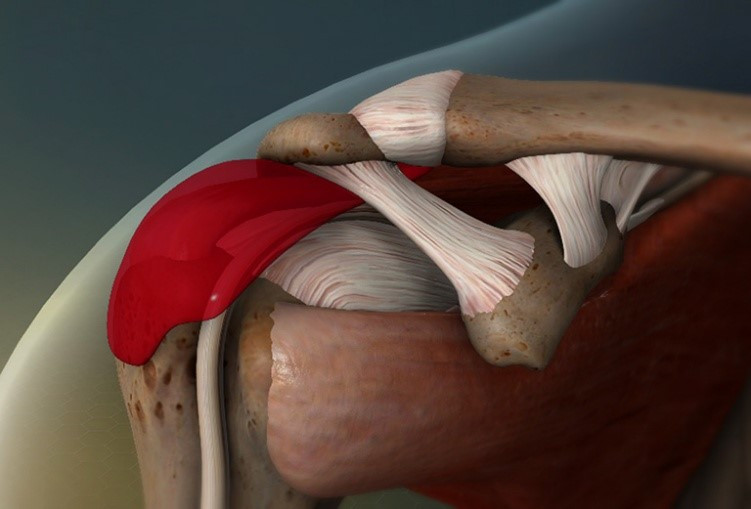Những bệnh lý khớp vai cần đặc biệt chú ý để không... tàn phế ảnh 4 Những bệnh lý khớp vai cần đặc biệt chú ý để không... tàn phế ảnh 4