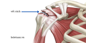 Những bệnh lý khớp vai cần đặc biệt chú ý để không... tàn phế ảnh 3 Những bệnh lý khớp vai cần đặc biệt chú ý để không... tàn phế ảnh 3