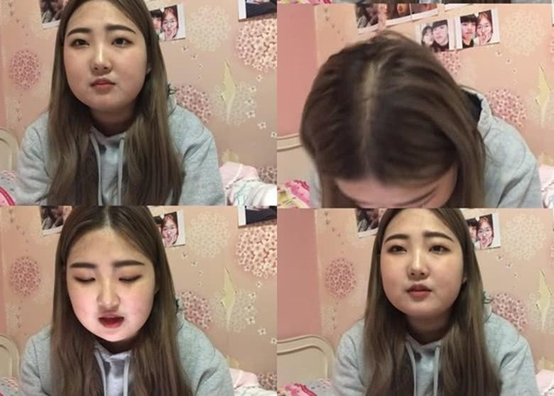 Năm 2019, Choi Joon Hee gây sốc với gương mặt phù nề và thân hình &quot;phát tướng&quot;. Thời điểm đó, thiếu nữ thế hệ Gen Z tiết lộ, bị chẩn đoán mắc bệnh Systemic Lupus Erythematosus (SLE) – tên khoa học của bệnh lupus ban đỏ hệ thống cấp tính. Căn bệnh quái ác khiến cô tăng 10kg chỉ trong 1-2 tuần. Đáng nói hơn, căn bệnh này không thể chữa khỏi, chỉ có thể điều trị để kiểm soát bệnh.