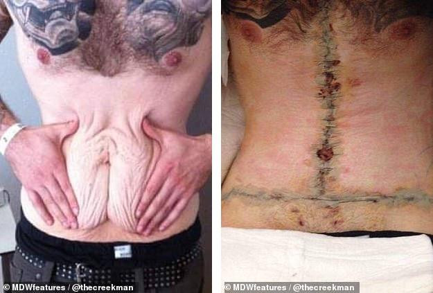 Sau khi giảm cân, anh có nhiều da thừa ở bụng. Đến lúc phẫu thuật cắt da, anh lại "đau đầu" vì sẹo. Sau khi giảm cân, anh có nhiều da thừa ở bụng. Đến lúc phẫu thuật cắt da, anh lại "đau đầu" vì sẹo.