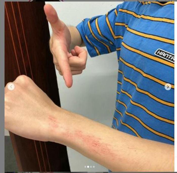 Nam ca sĩ cũng đính kèm những hình ảnh trầy da tróc vẩy sau &quot;cuộc chiến&quot; nảy lửa giữa các thành viên của Running Man.