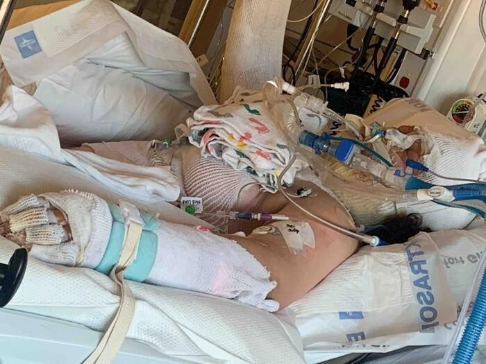 Một bé gái bị bỏng nặng toàn thân sau khi tập làm theo thử thách trên TikTok.