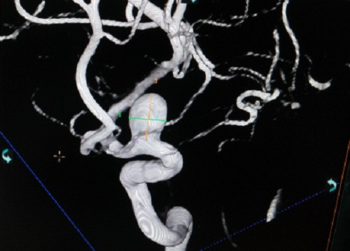 Sau cơn đau đầu, người phụ nữ tá hỏa khi phát hiện mạch não phình to bằng quả nho - 1