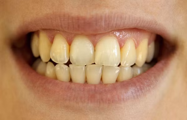 Loạt biến chứng nguy hiểm từ việc lười đánh răng ảnh 1