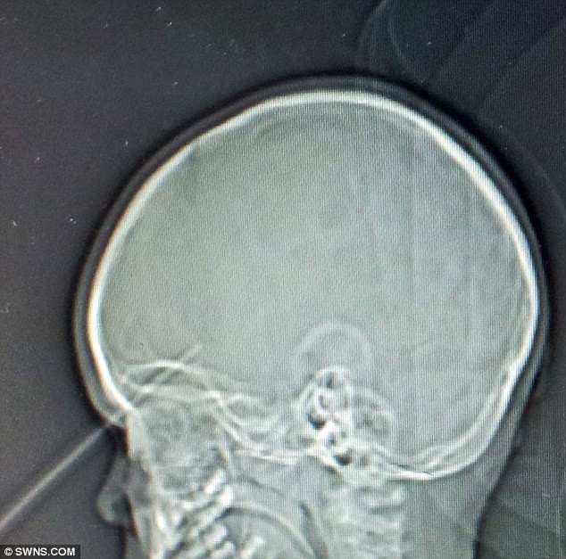 Ảnh chụp X-quang não cô bé.. Ảnh chụp X-quang não cô bé.