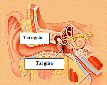 Viêm tai giữa dễ gây thủng màng nhĩ