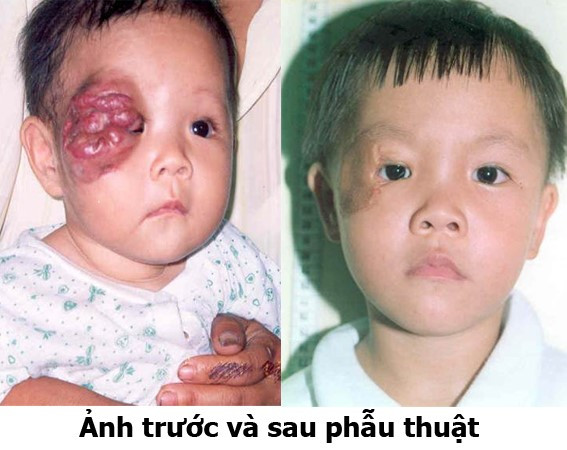 U máu ở trẻ: Chớ chủ quan, coi chừng nguy hiểm ảnh 2