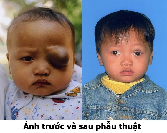 U máu ở trẻ: Chớ chủ quan, coi chừng nguy hiểm ảnh 3